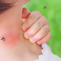 mosquito bites
