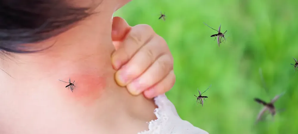 mosquito bites
